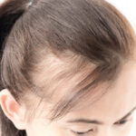 Alopecia Awareness