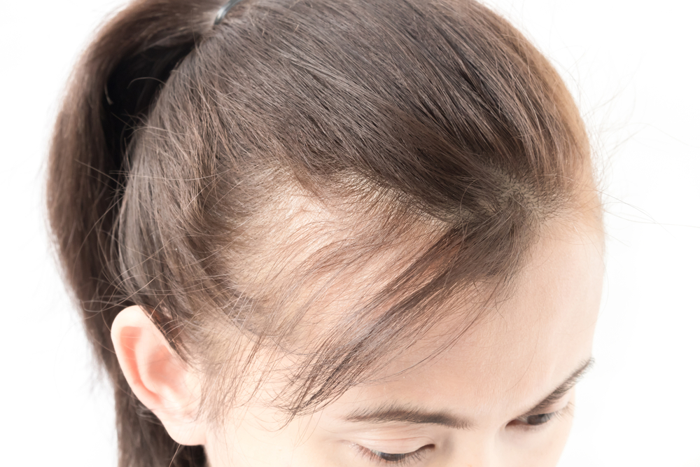 Read more about the article Alopecia Awareness